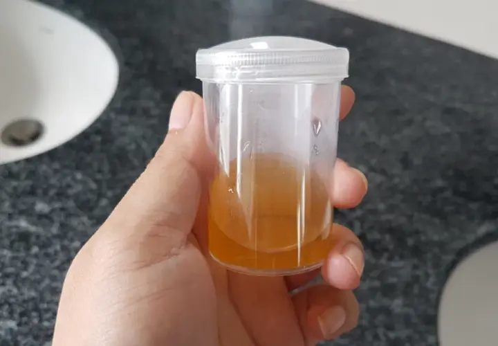 Próbka moczu z widocznymi fosforanami bezpostaciowymi.