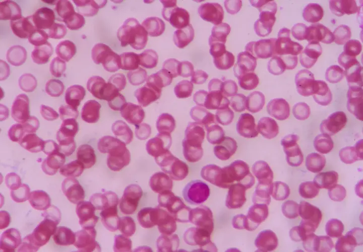Widoczne liczne czerwone krwinki o zróżnicowanych kształtach i rozmiarach, co wskazuje na anizocytozę erytrocytów. W centrum obrazu pojedynczy, fioletowy leukocyt.
