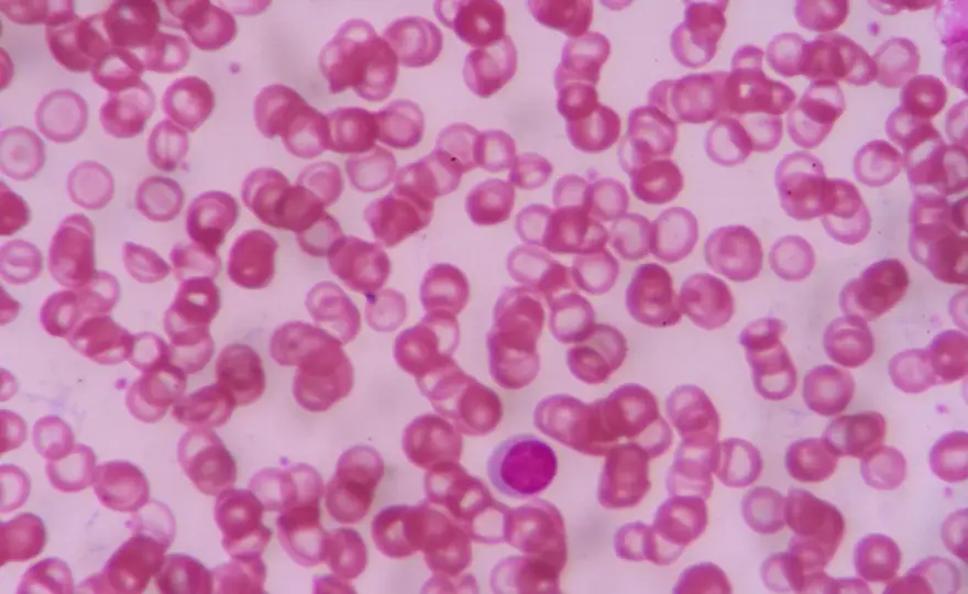 Anizocytoza erytrocytów - Co oznacza wysokie RDW?