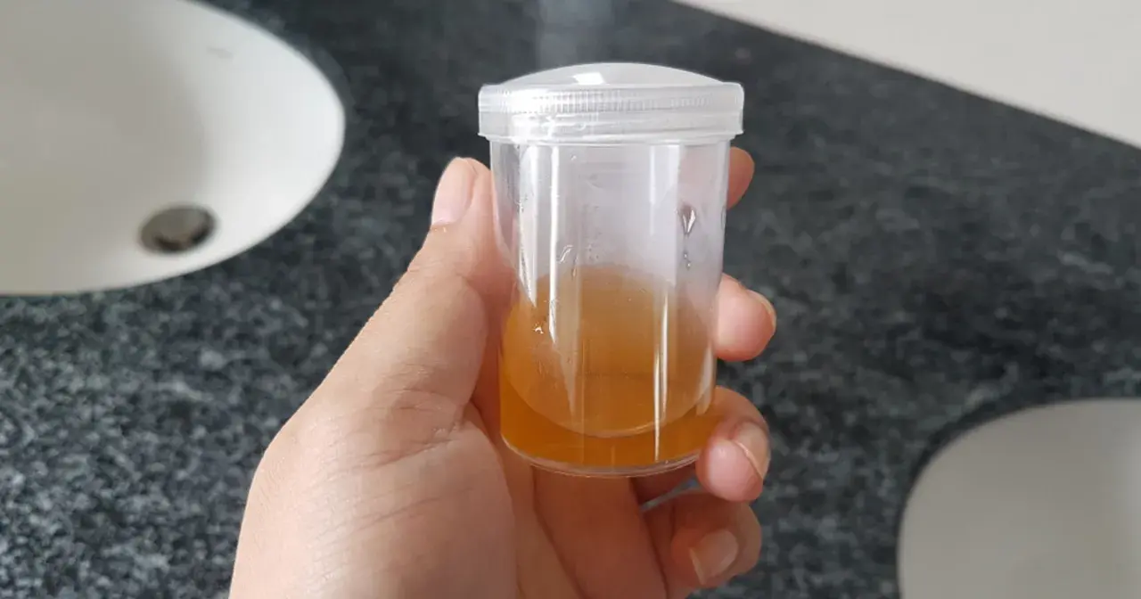 Próbka moczu z widocznymi fosforanami bezpostaciowymi.