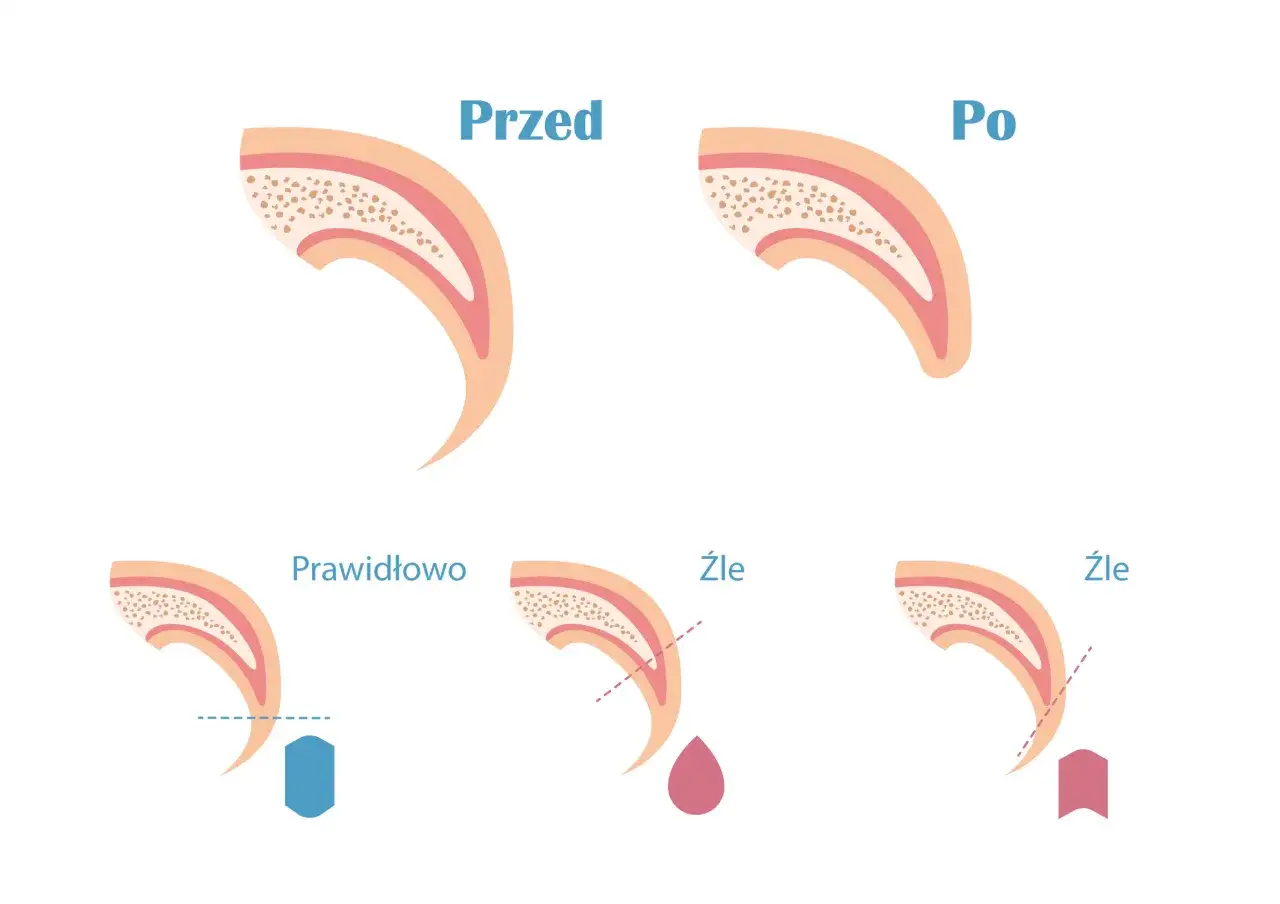 Ilustracja pokazuje przekrój pazura psa przed i po przycięciu, a także prawidłowe i nieprawidłowe przycinanie. Przerośnięte pazury u psa mogą prowadzić do bólu.